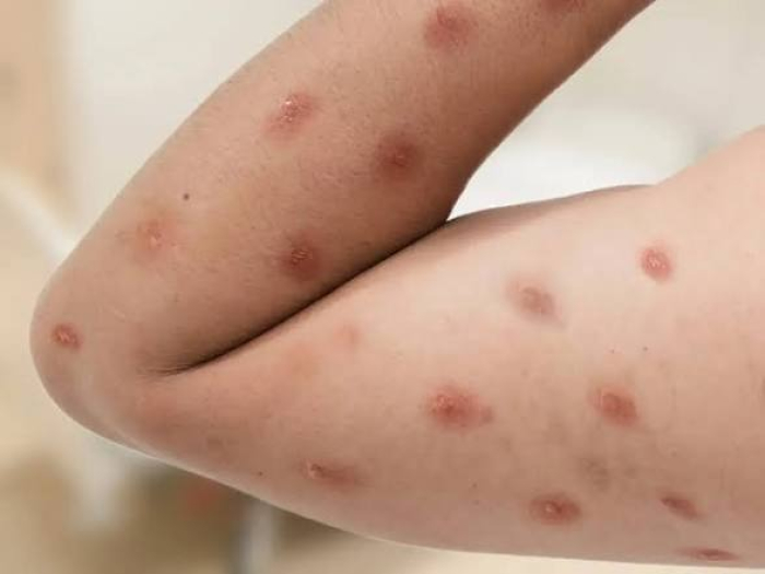 Casos de Mpox voltam a crescer no Brasil em 2026 e autoridades reforçam vigilância